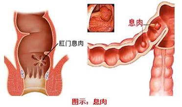 还有肛门息肉这种病?